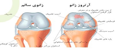 آرتروز
